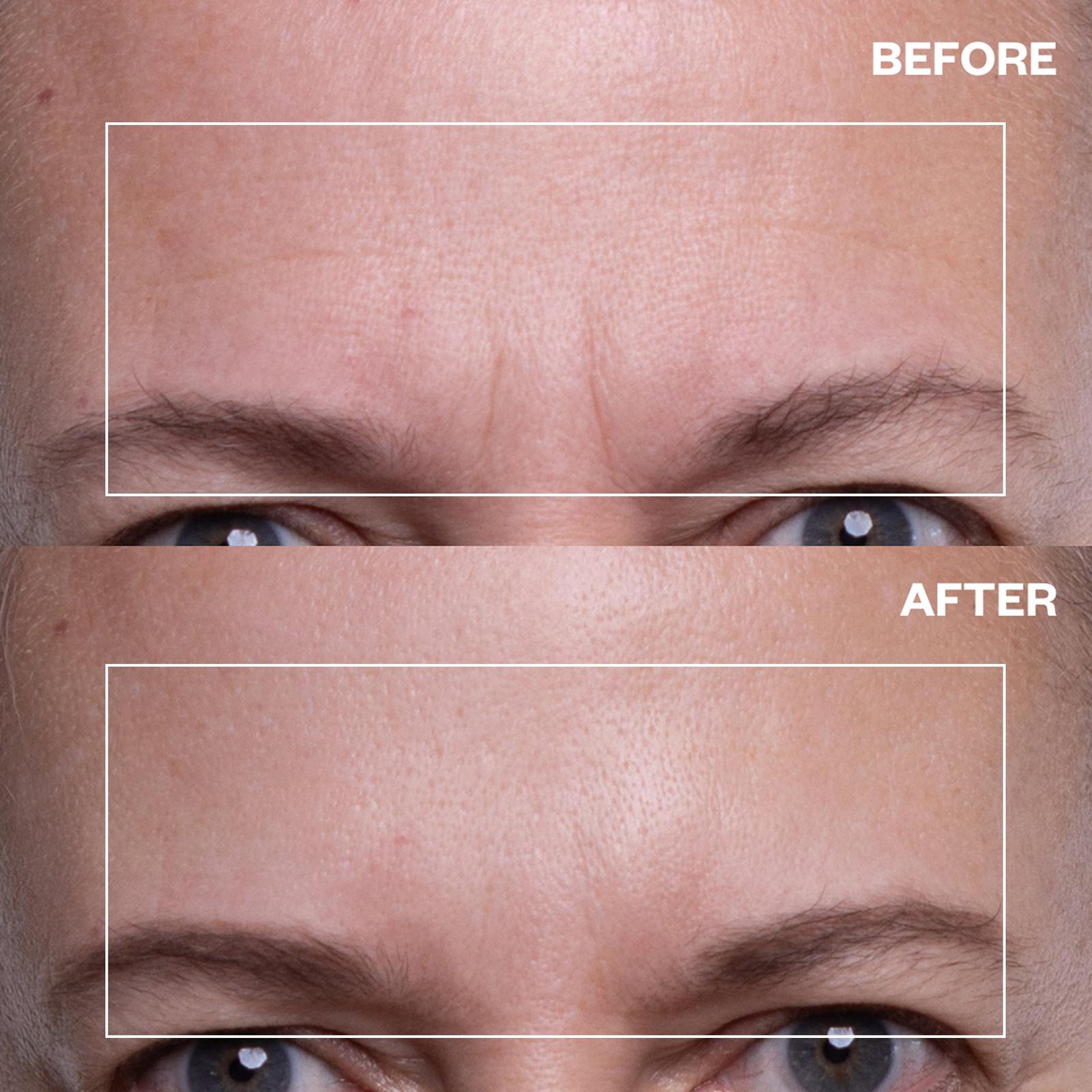 Forehead Wrinkle Patch