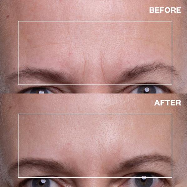 Wrinkles Schminkles Forehead Wrinkle Patch #3