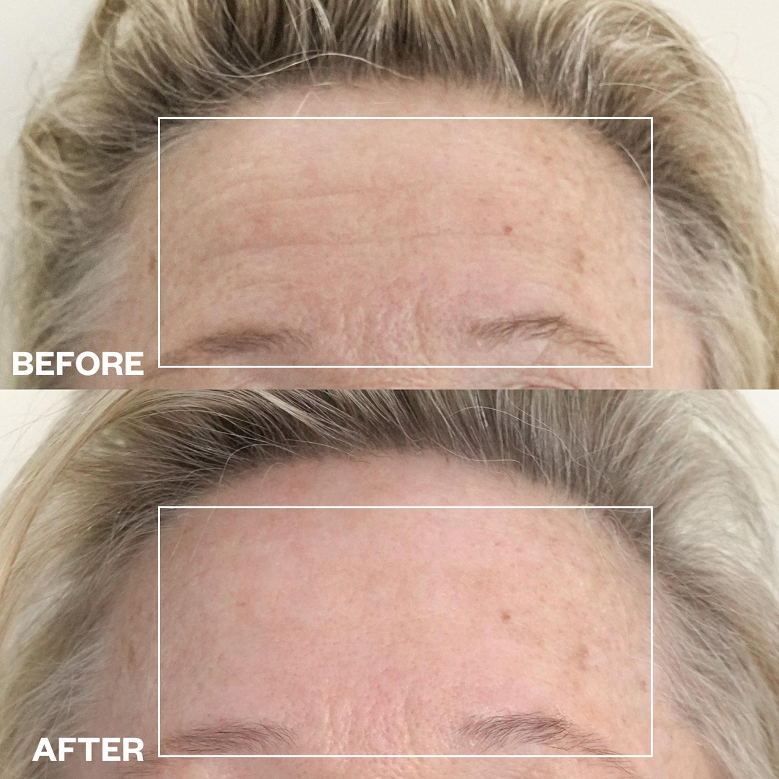 Forehead Wrinkle Patch