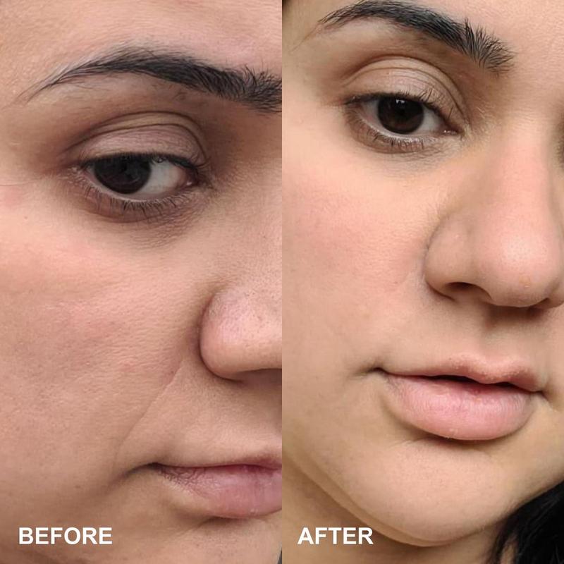 semaglutide microneedle patches Frontiers Wrinkles Schminkles - Self-Dissolving Microneedle