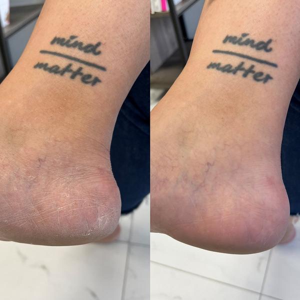 nu119 Platinum Peel (Starter Kit w/ Foot File) #4