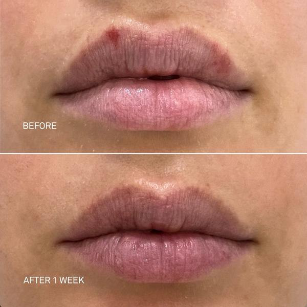 RescueMD Restorative Lip Treatment #5