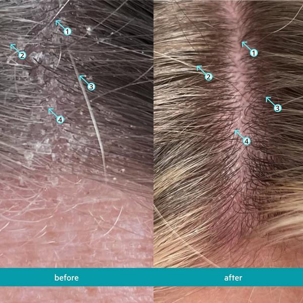 DS Laboratories Dandrene Exfoliating Anti-Dandruff Shampoo #5