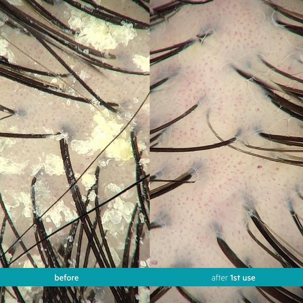 DS Laboratories Dandrene Exfoliating Anti-Dandruff Shampoo #6