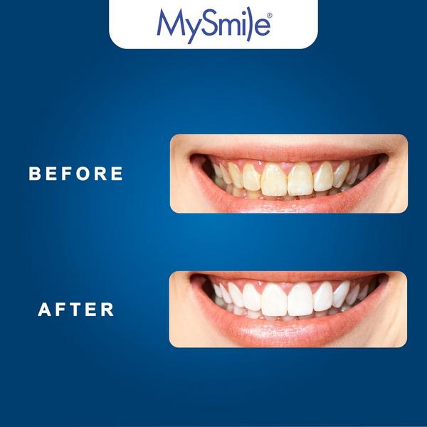 MySmile 5X Original Accelerated Teeth Whitening LED Light #3