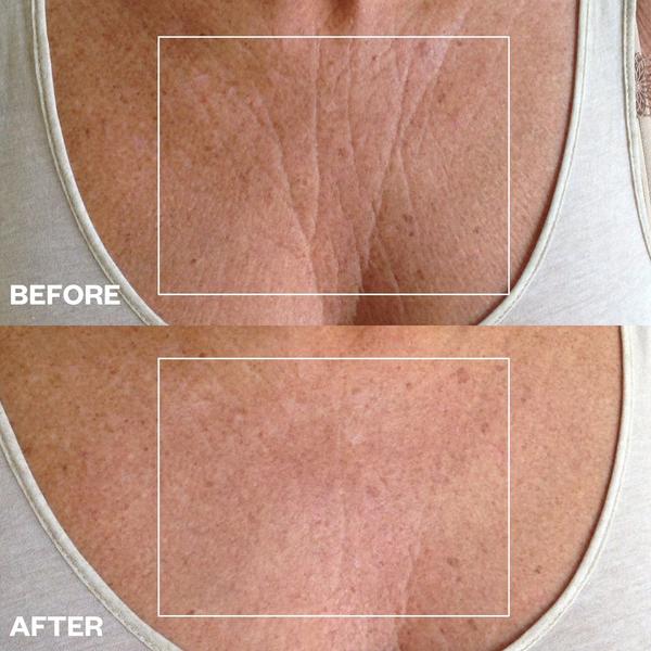 Wrinkles Schminkles Chest Wrinkle Patch #3