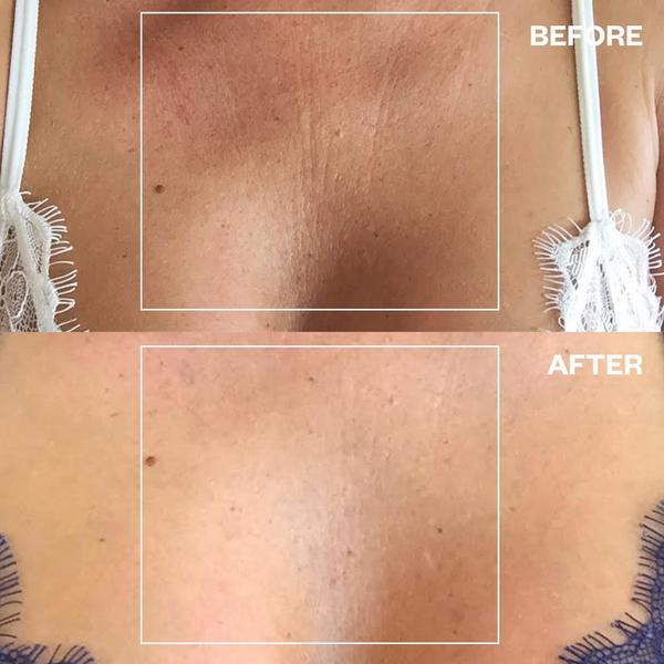 Wrinkles Schminkles Chest Wrinkle Patch #5