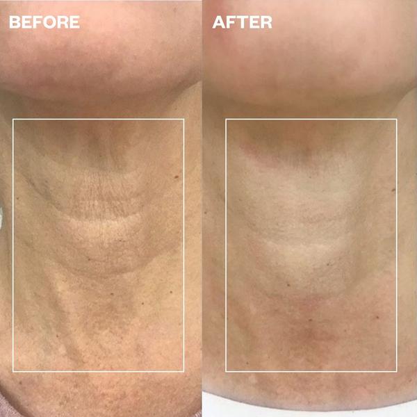 Wrinkles Schminkles Neck Wrinkle Patch #5