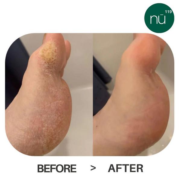 nu119 Platinum Peel #2