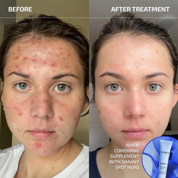 Codex Labs Shaant Clear Skin Probiotic Supplement 2.0 #2