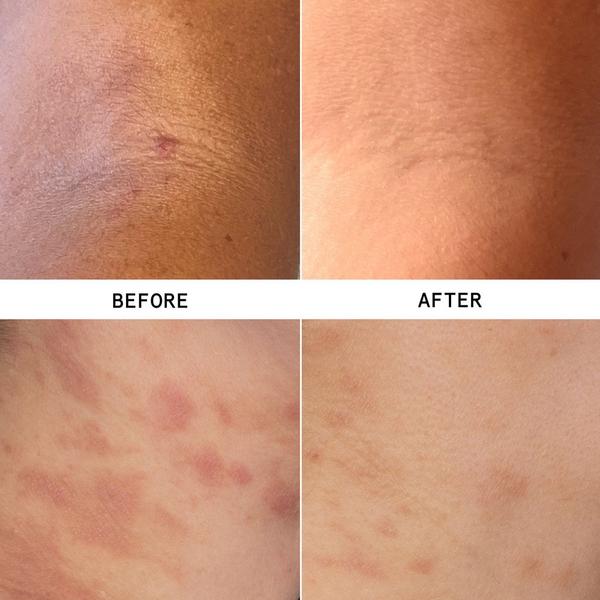 Hypothesis Eczema Precision Kit #2