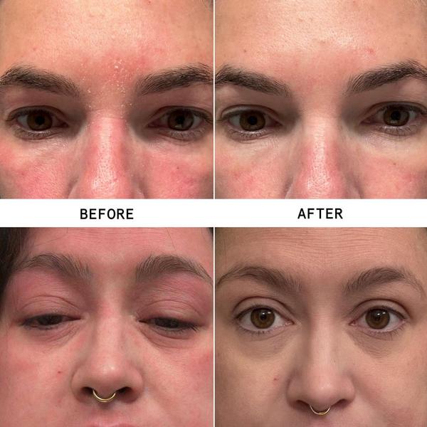 Hypothesis Eczema Precision Hydrogel #2