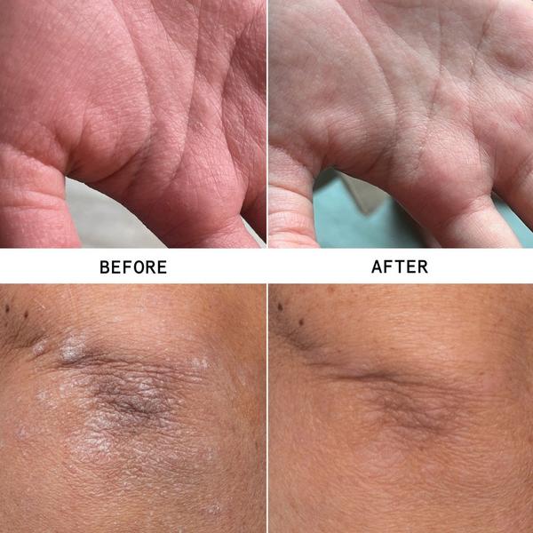 Hypothesis Eczema Therapy Cream #2