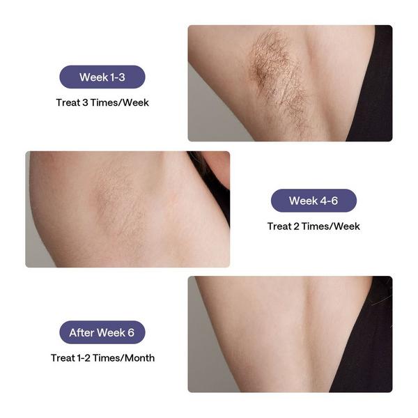 Ulike Air3 IPL Hair Removal Device #7