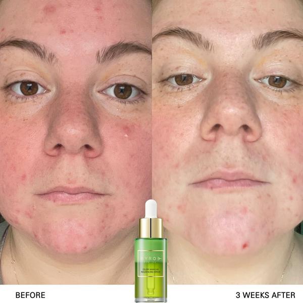 BYROE Celery AHA+LHA Resurfacing Serum #5