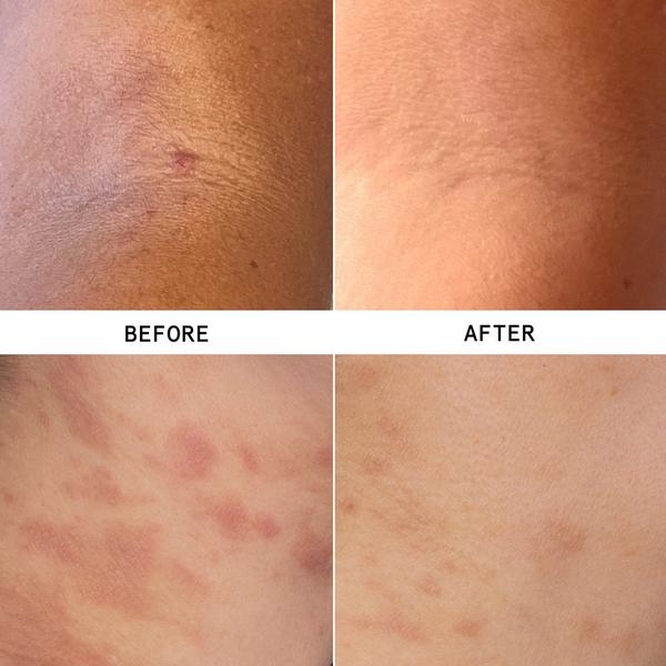 Hypothesis Eczema Relief + Repair Duo #2