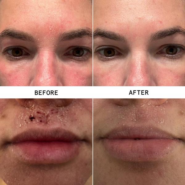 Hypothesis Eczema Relief + Repair Duo #3