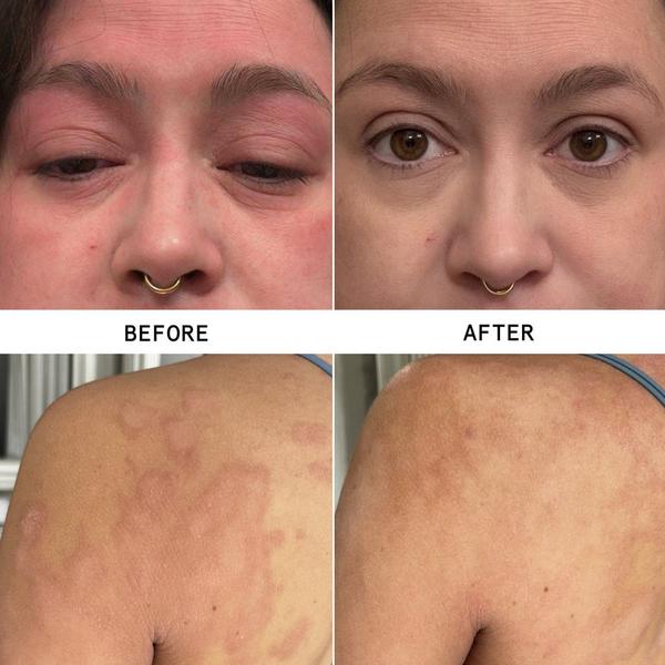 Hypothesis Eczema Travel Trio #2