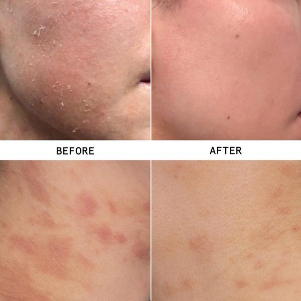 Hypothesis Eczema Travel Trio #3