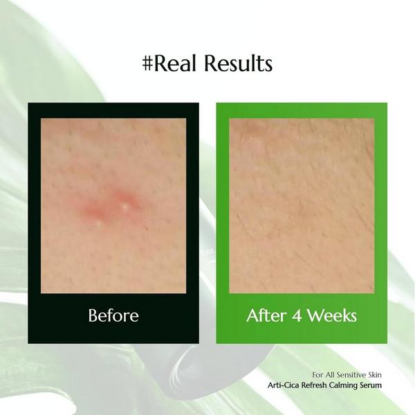 Molvany Arti-Cica Refresh Calming Serum #5