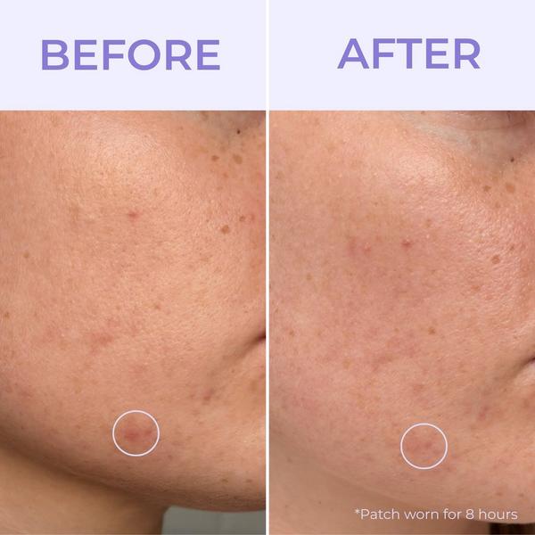 Evre Skincare Stick With Me Pimple Patches #2