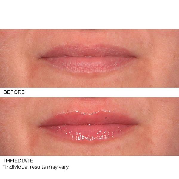 NassifMD Skincare Hydro-Screen Lip Plumper #5