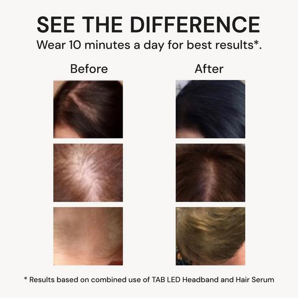 Tech Activated Beauty LED Scalp Therapy Headband #3