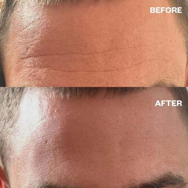 Wrinkles Schminkles Men's Pro Forehead Wrinkle Patch #6