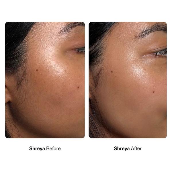 Nimbi Skin Renewal Facial Dermaplaners #6