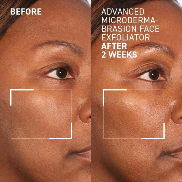 Dr. Brandt Advanced Microdermabrasion Face Exfoliator #3