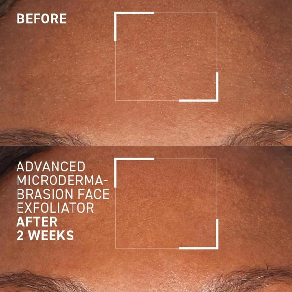 Dr. Brandt Advanced Microdermabrasion Face Exfoliator #7