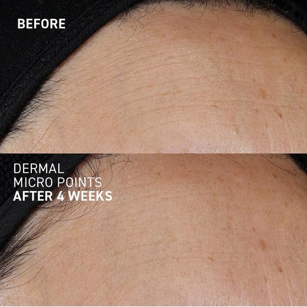 Dr. Brandt Dermal Micro Points #8