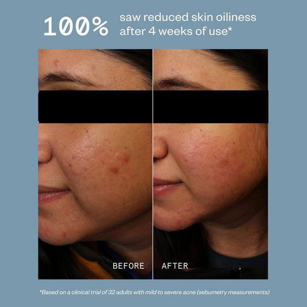 Hypothesis Daily Acne Cleanser #4