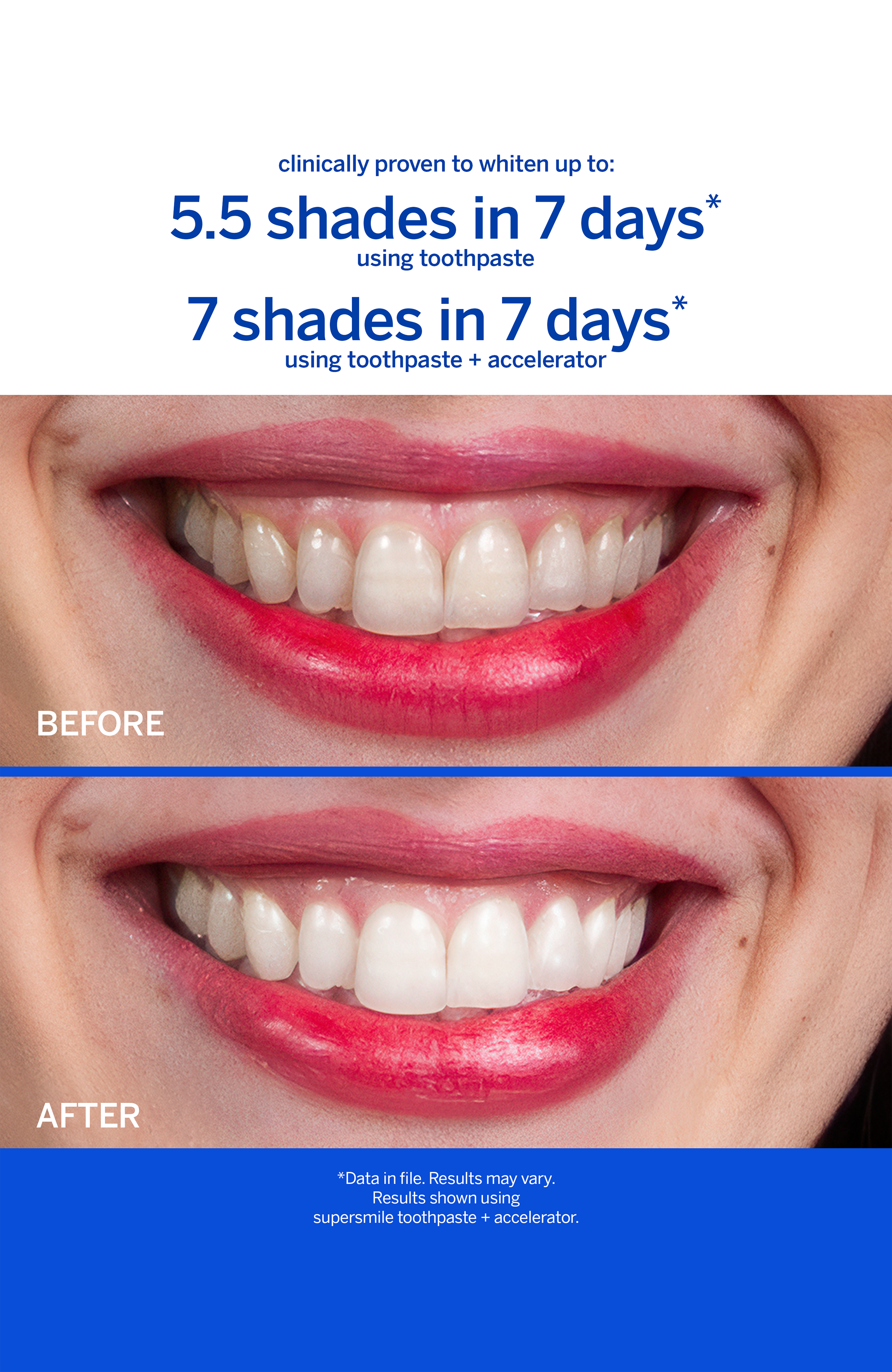 Supersmile Whitening System - Thumbnail 5