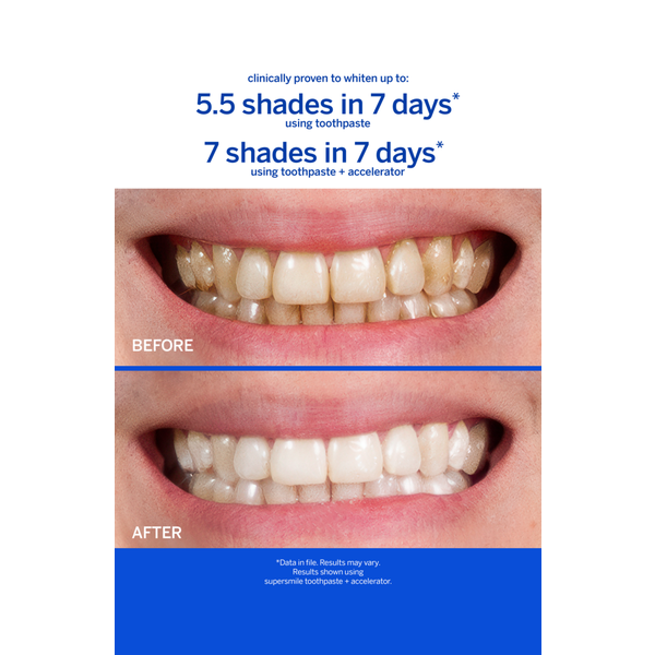 Supersmile Fluoride Free Professional Whitening System #4