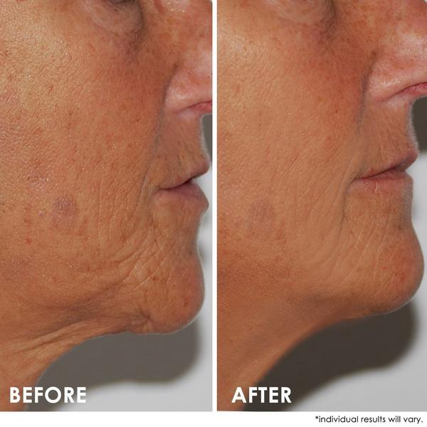 Dermelect Self-Esteem Neck Firming Lift #2