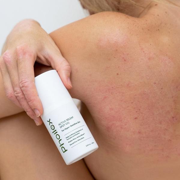 Phoilex Active ReLeaf Spot Gel #5