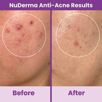 Pure Daily Care NuDerma Standard High Frequency Wand w/Argon Applicators #5