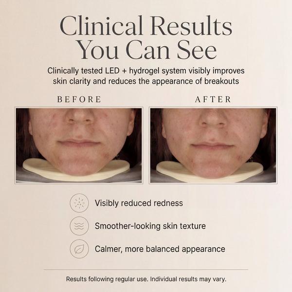 Metamorphosis SuperStar Hydrogel Pimple Patches #4