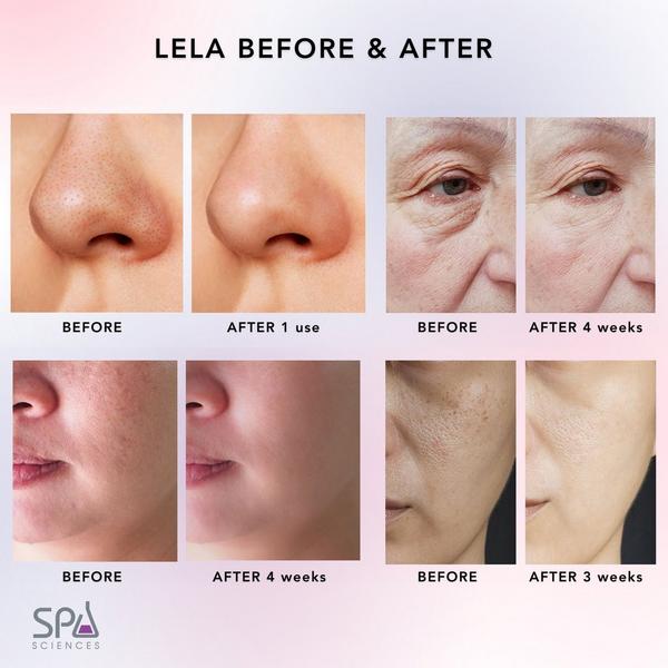 Spa Sciences LELA 4-in-1 Ultrasonic Facial Skin Spatula #5