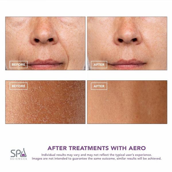 Spa Sciences AERO Advanced Skincare Infusion System #4