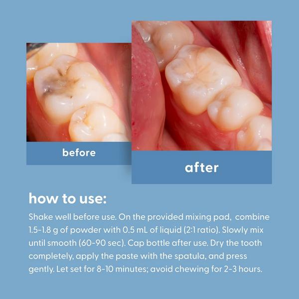 M3 Dental Tooth Repair Kit #4