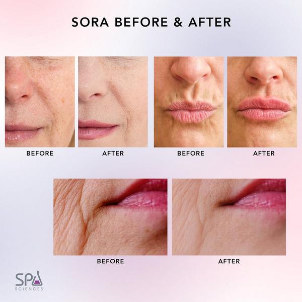Spa Sciences SORA 12 Pin Microneedling Replacement Kit #5
