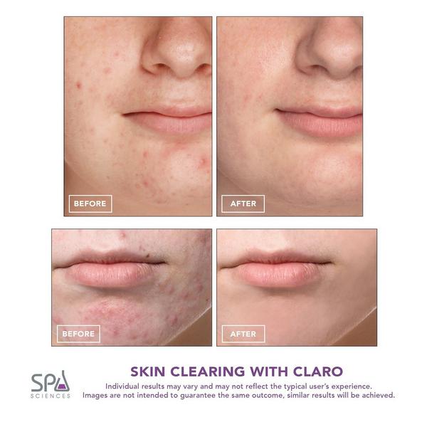 Spa Sciences CLARO - Acne Treatment Light Therapy System #4