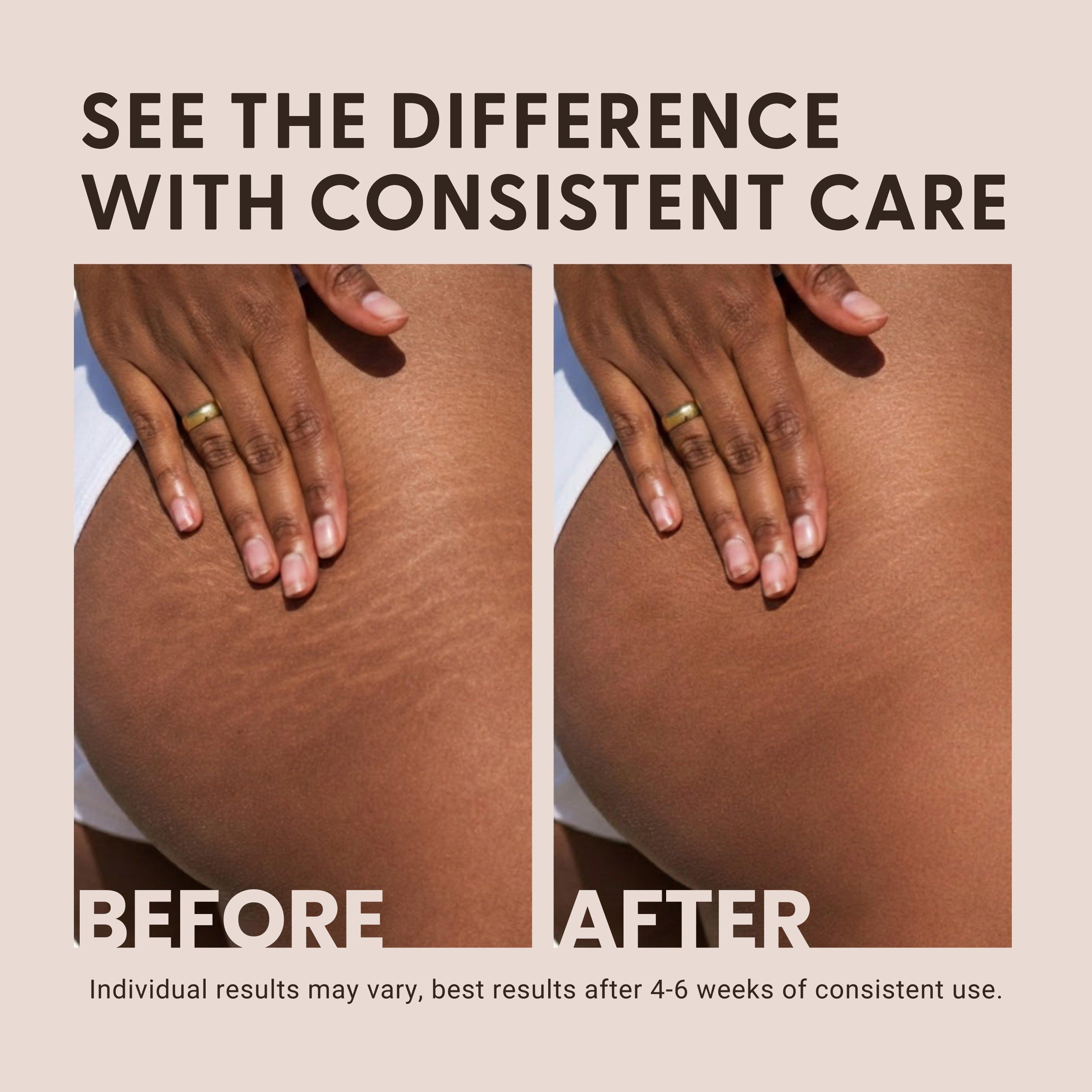 M3 Stretch Mark Cream — фото 7